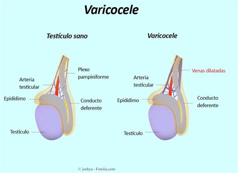 varicele testiculare la bărbații la care se efectuează intervenția chirurgicală